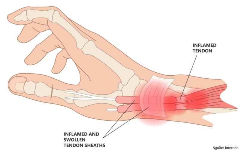 ĐIỀU TRỊ VIÊM GÂN DUỖI NGÓN CÁI