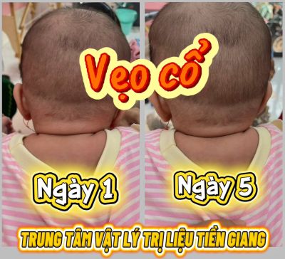 VẸO CỔ BẨM SINH - CH&Uacute;C MỪNG CON Đ&Atilde; B&Igrave;NH THƯỜNG TRỞ LẠI SAU 5 NG&Agrave;Y TẬP LUYỆN