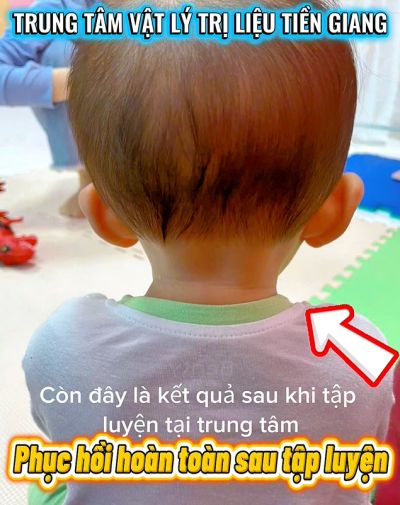 VẸO CỔ BẨM SINH - CH&Uacute;C MỪNG CON Đ&Atilde; PHỤC HỒI HO&Agrave;N TO&Agrave;N!