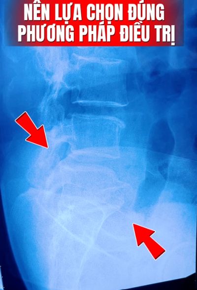 ĐỪNG GIỠN VỚI CỘT SỐNG CỦA M&Igrave;NH!