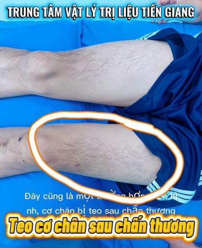 TEO CƠ CH&Acirc;N SAU CHẤN THƯƠNG