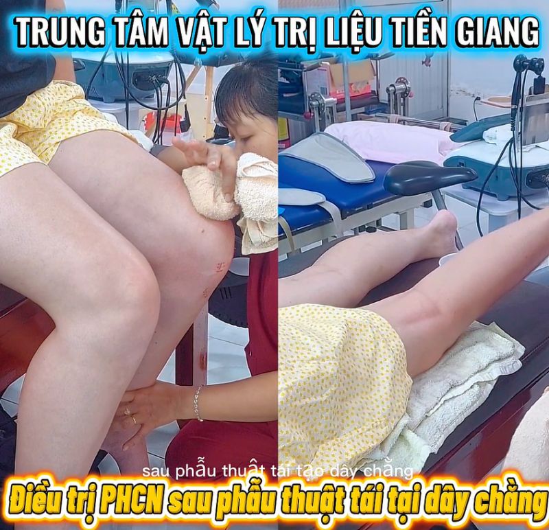 TẬP PHỤC HỒI SAU MỔ D&Acirc;Y CHẰNG: Đ&Uacute;NG THỜI ĐIỂM &ndash; Đ&Uacute;NG CƯỜNG ĐỘ