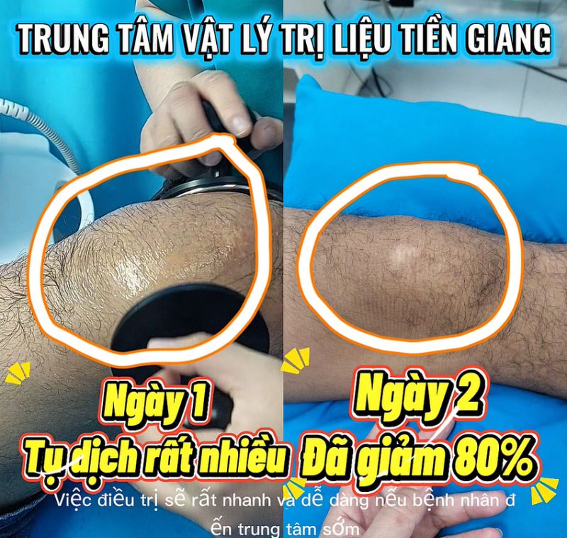 Tối ưu h&oacute;a thời gian điều trị tụ dịch khớp gối: Tầm quan trọng của việc can thiệp đ&uacute;ng v&agrave; kịp thời