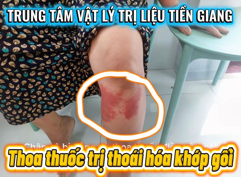 CẢNH B&Aacute;O: SAI LẦM KHI TỰ &Yacute; ĐIỀU TRỊ VI&Ecirc;M KHỚP GỐI TẠI NH&Agrave;