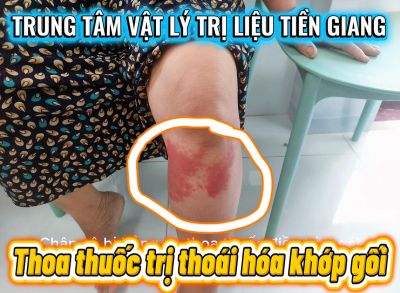 CẢNH B&Aacute;O: SAI LẦM KHI TỰ &Yacute; ĐIỀU TRỊ VI&Ecirc;M KHỚP GỐI TẠI NH&Agrave;
