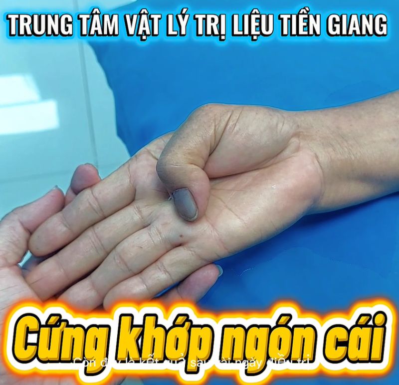 CỨNG KHỚP NG&Oacute;N TAY C&Aacute;I - 1 NĂM UỐNG THUỐC KH&Ocirc;NG BẰNG V&Agrave;I NG&Agrave;Y TẬP VẬT L&Yacute; TRỊ LIỆU