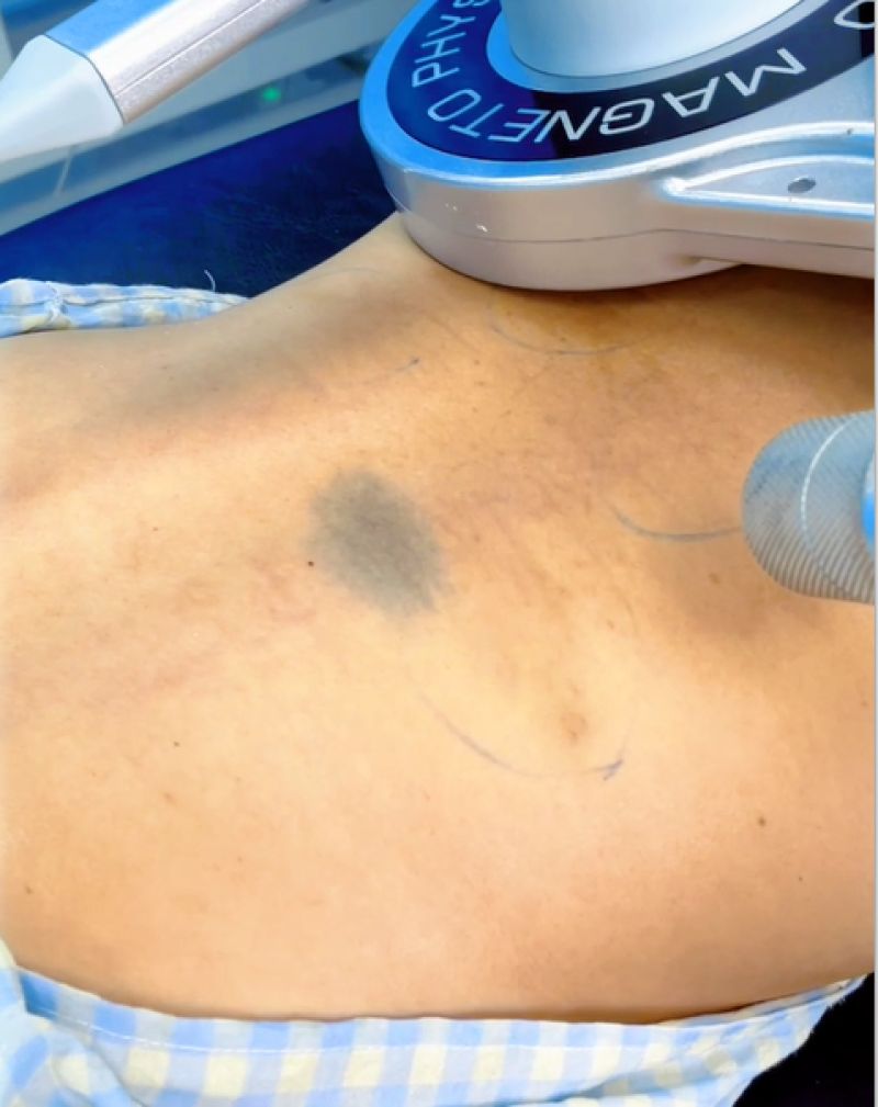 C&Acirc;U CHUYỆN CỦA MỘT BẠN TRẺ BỊ ĐAU LƯNG