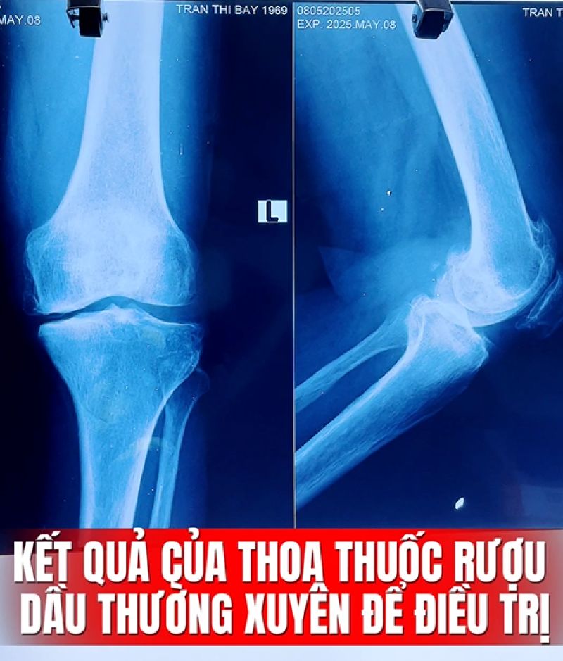 THOA THUỐC RƯỢU V&Agrave; DẦU N&Oacute;NG ĐỂ ĐIỀU TRỊ KHỚP GỐI - KẾT QUẢ L&Agrave; Đ&Acirc;Y