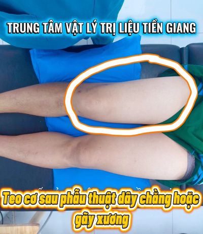TEO CƠ SAU CHẤN THƯƠNG: TẠI SAO CHỈ TẬP "TẦM VẬN ĐỘNG" L&Agrave; CHƯA ĐỦ?
