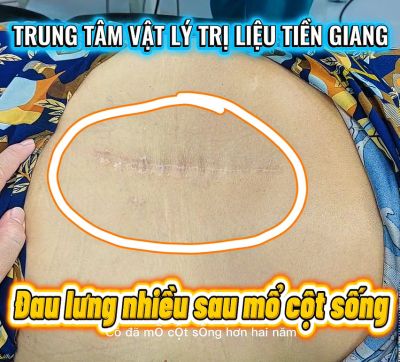 ĐAU LƯNG K&Eacute;O D&Agrave;I SAU PHẪU THUẬT: ĐỪNG CHỦ QUAN