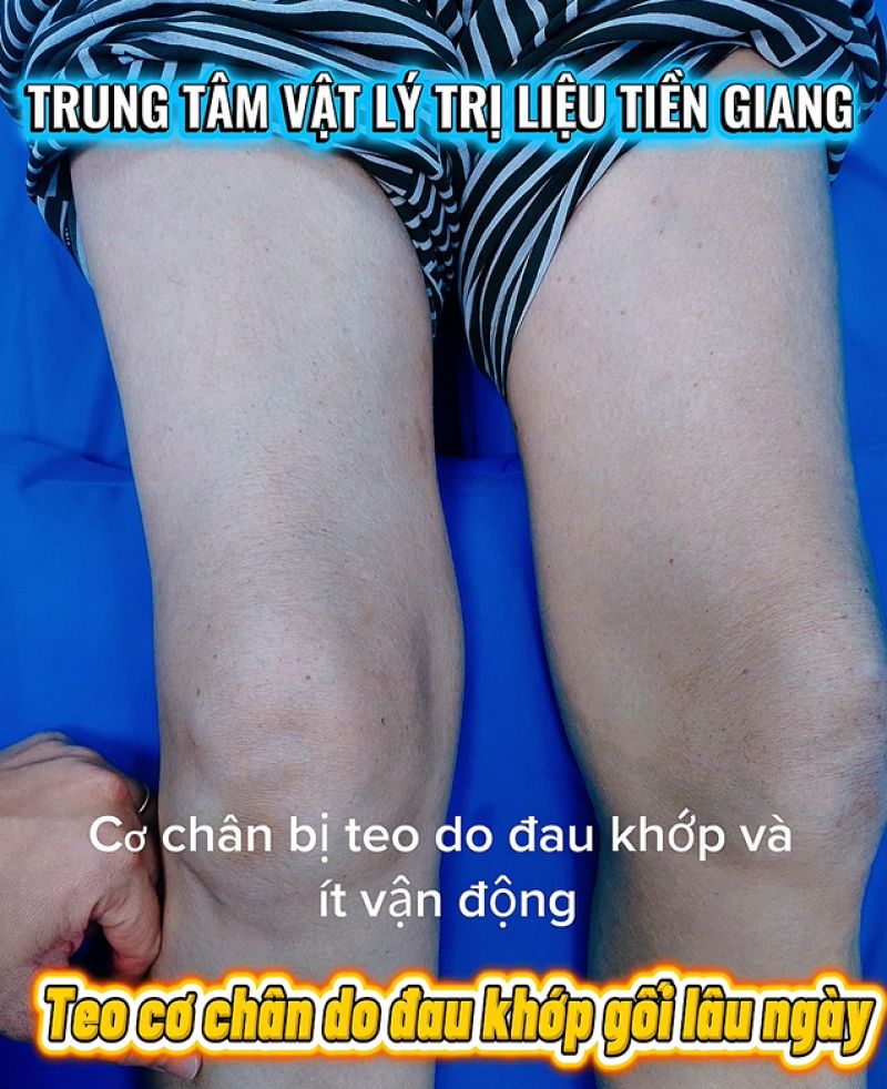 THO&Aacute;I H&Oacute;A KHỚP GỐI - KH&Ocirc;NG CHỈ L&Agrave; HẾT ĐAU - TẠI SAO PHẢI PHỤC HỒI HỆ CƠ CH&Acirc;N