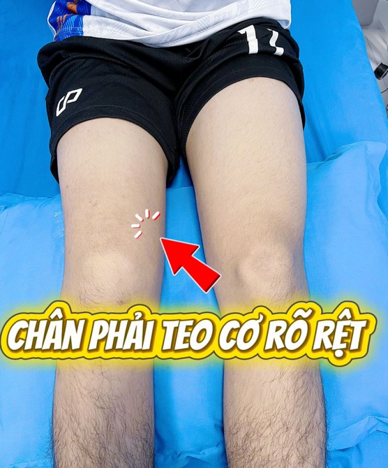 TEO CƠ CH&Acirc;N DO CHỈ TẬP LUYỆN TẠI NH&Agrave; SAU MỔ T&Aacute;I TẠO D&Acirc;Y CHẰN KHỚP GỐI